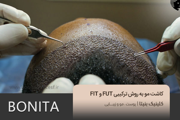 کاشت مو به روش ترکیبی fut و fit