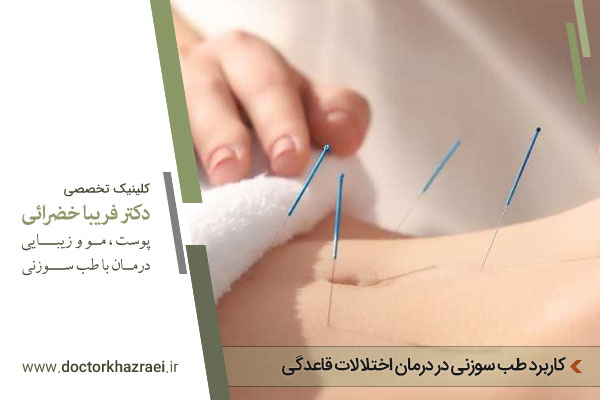 طب سوزنی برای قاعدگی