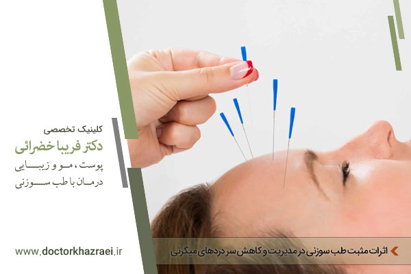 طب سوزنی میگرن