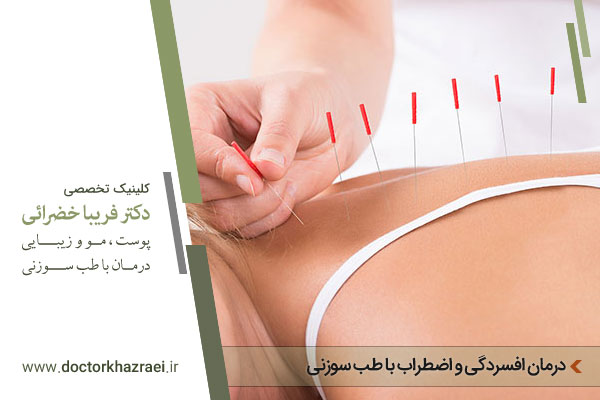 طب سوزنی و درمان افسردگی