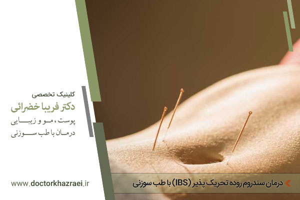 طب سوزنی سندرو روده تحریک پذیر IBS