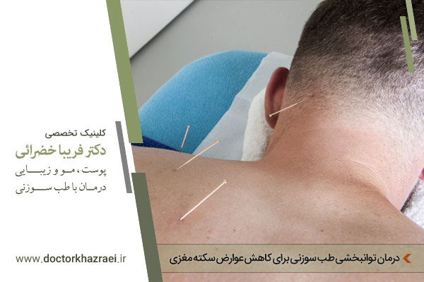 طب سوزنی پس از سکته مغزی