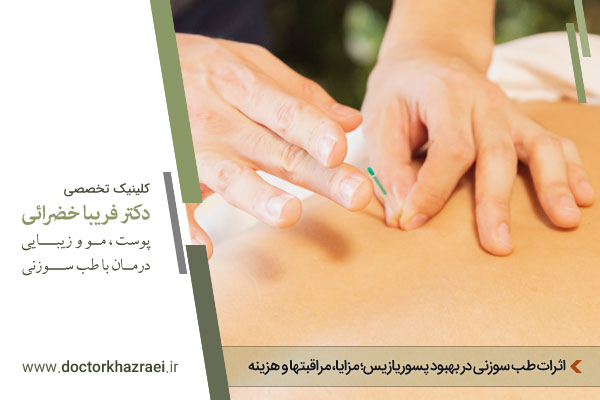 طب سوزنی برای بهبود پسوریازیس