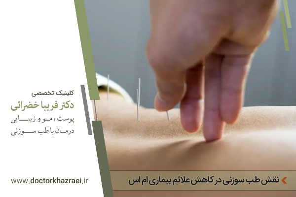 طب سوزنی برای درمان بیماری ام اس 