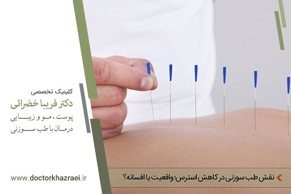 کاهش استرس با طب سوزنی 