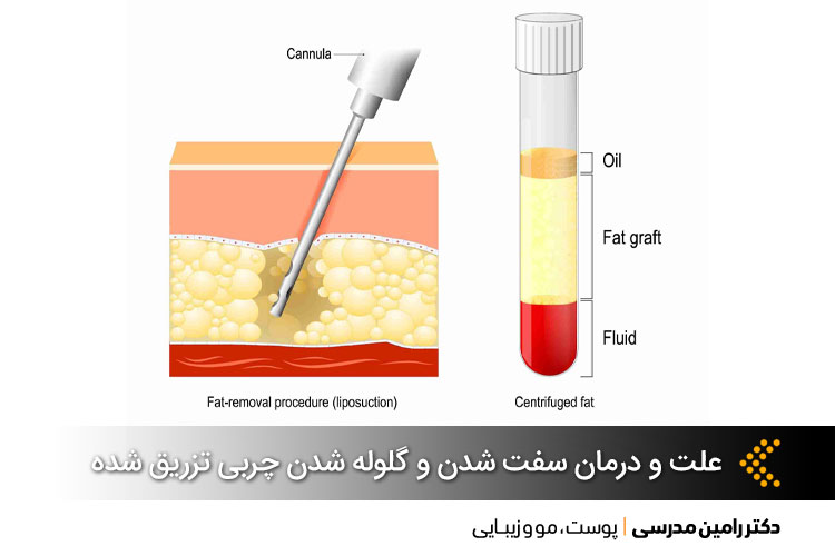 علت و درمان سفت شدن و گلوله شدن چربی تزریق شده