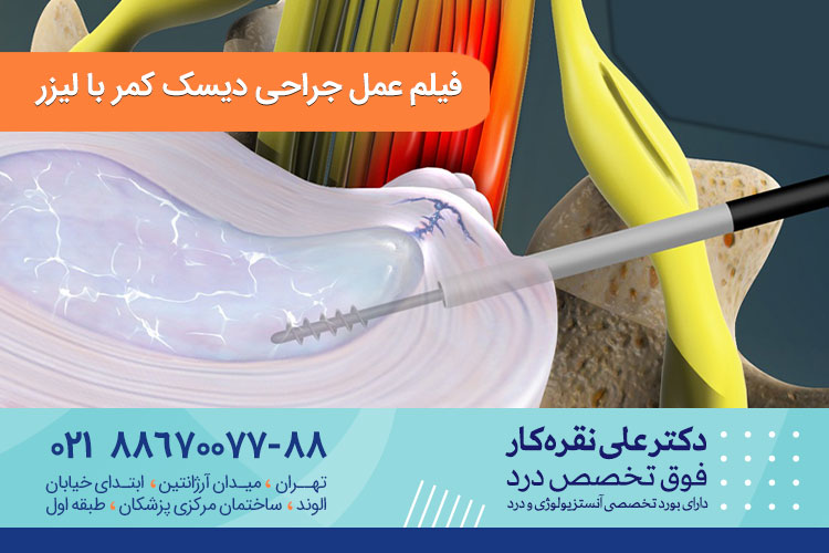 عمل جراحی دیسک کمر با لیزر 