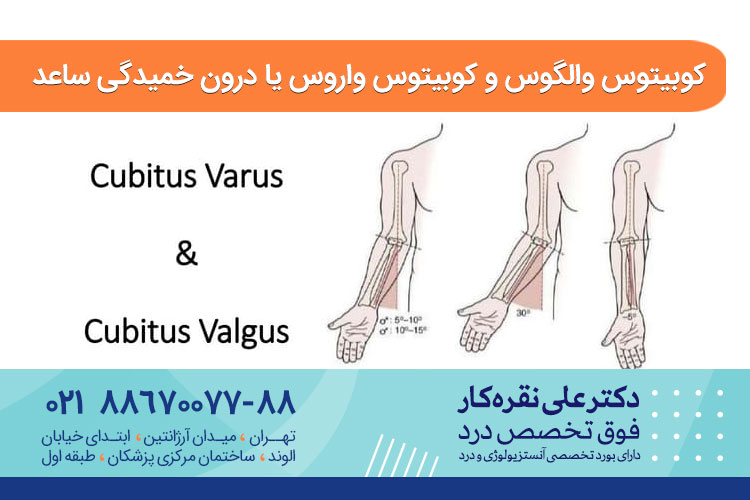 کوبیتوس والگوس و کوبیتوس واروس یا درون خمیدگی ساعد