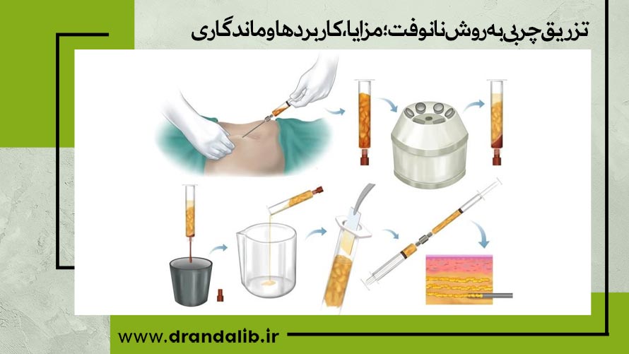 تزریق چربی به روش نانوفت