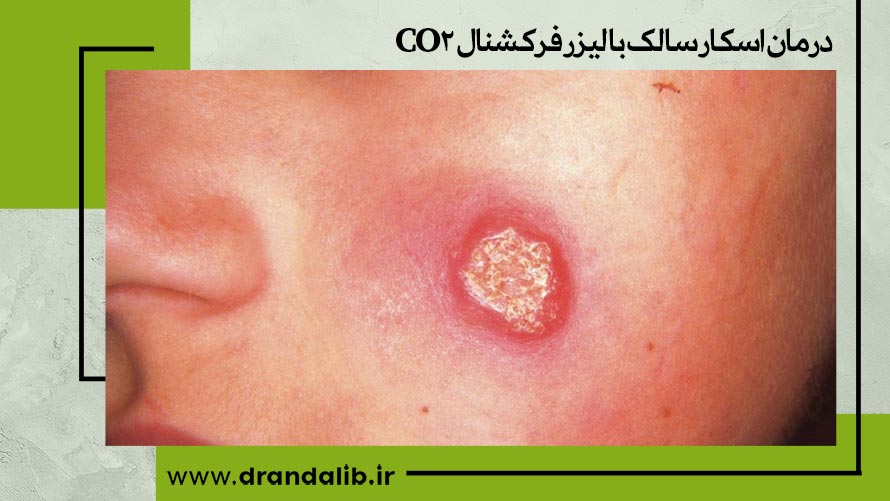 درمان اسکار سالک با لیزر فرکشنال co2