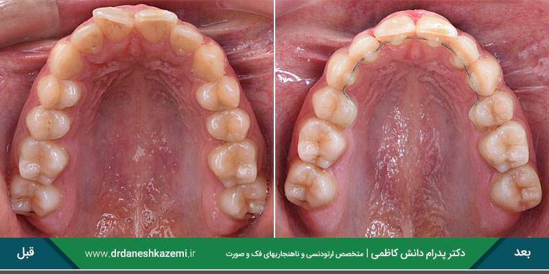 مرتب سازی باکشیدن دندان در ارتودنسی