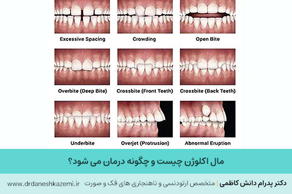 عکس مال اکلوژن