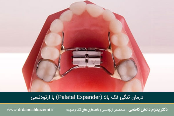 ارتودنسی تنگی فک بالا