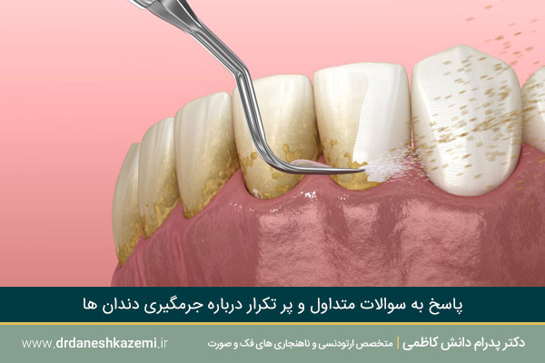 مهمترین نکات و پرسش و پاسخ جرمگیری دندان