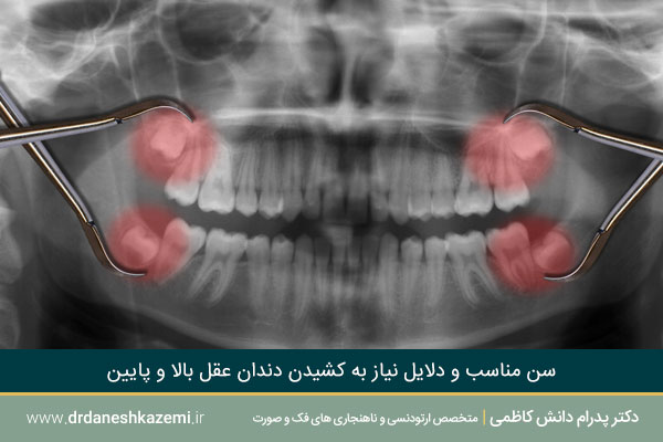 کشیدن دندان عقل بدون جراحی و با جراحی