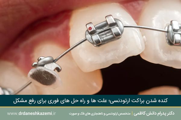 عکس کنده شدن براکت ارتودنسی 