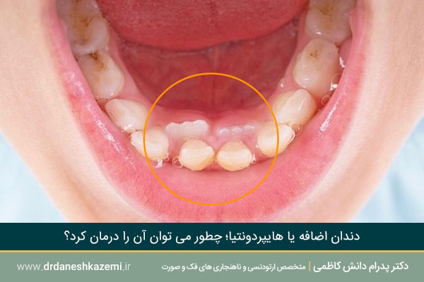 هایپردونتیا چیست