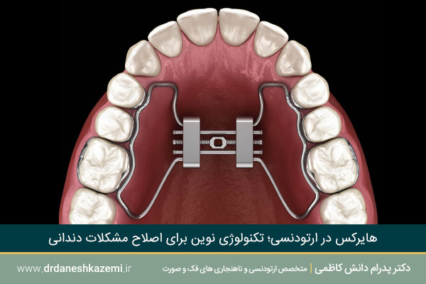 کاربرد هایرکس در ارتودنسی 