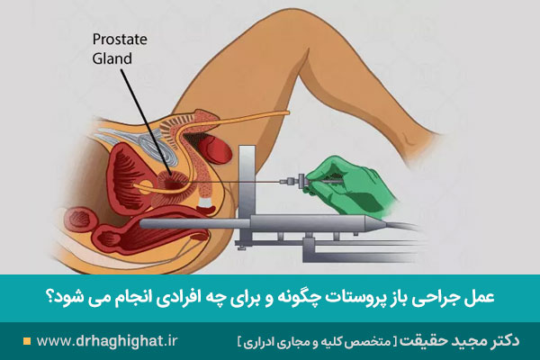 جراحی باز پروستات