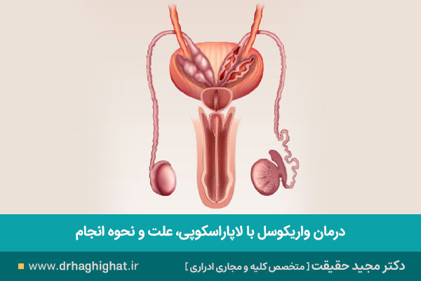 عمل لاپاراسکوپی واریکوسل