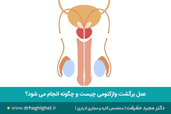 عمل برگشت وازکتومی چیست