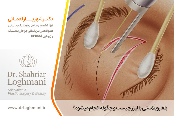 عمل بلفاروپلاستی با لیزر