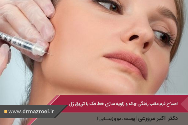 زاویه سازی خط فک با تزریق ژل