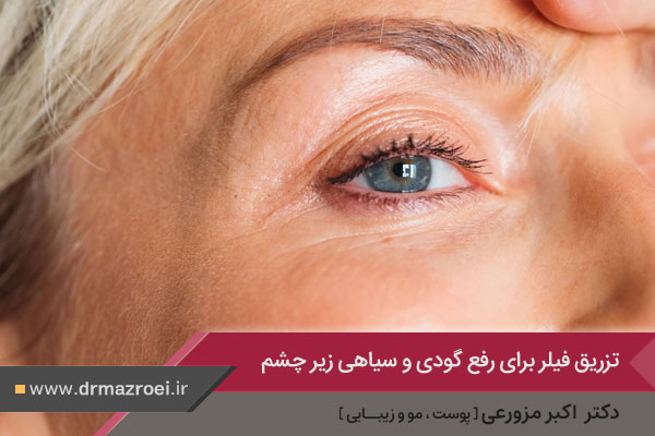 تزریق فیلر برای رفع گودی و سیاهی زیر چشم