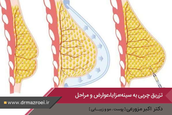 تزریق چربی به سینه 