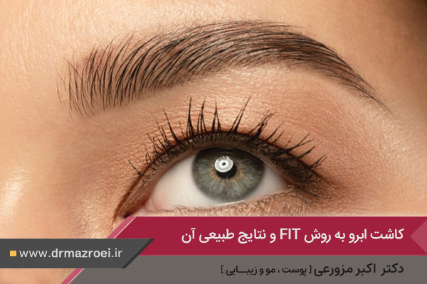 کاشت ابرو به روش fit در اصفهان 