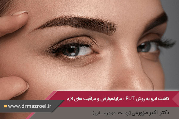 کاشت ابرو به روش fut در اصفهان