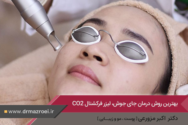 درمان جای جوش و اسکار آکنه با لیزر فرکشنال co2