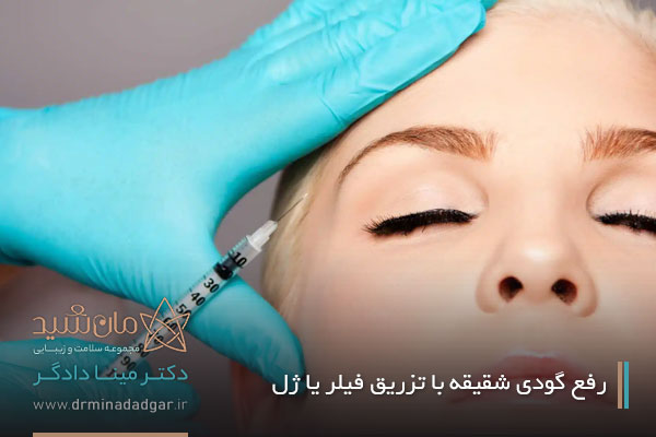 رفع گودی شقیقه با تزریق فیلر یا ژل