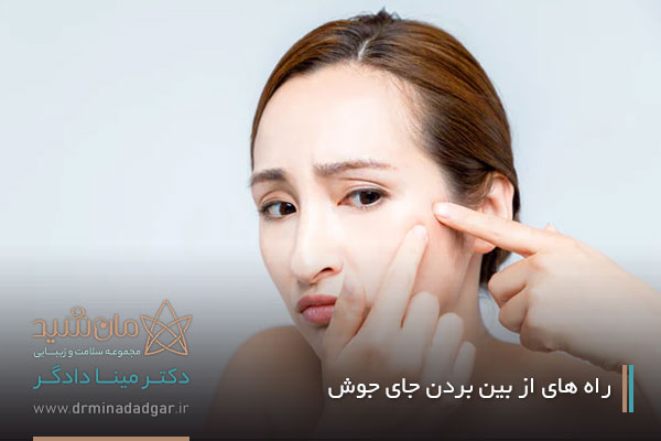 از بین بردن جای جوش در اصفهان 