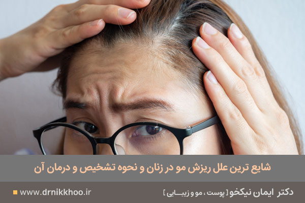 ریزش مو در زنان