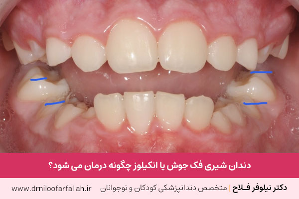 دندان شیری فک جوش