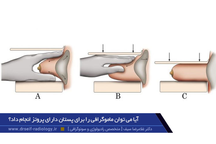 ماموگرافی سینه پروتز شده