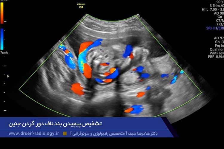 بند ناف دور گردن جنین