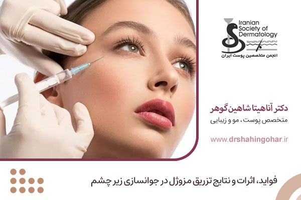 تزریق مزوژل جوانساز زیر چشم