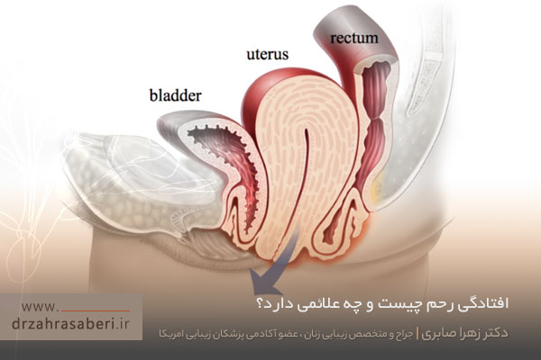 افتادگی رحم 