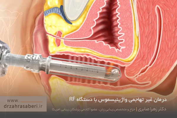 درمان واژینیسموس با دستگاه آر اف 