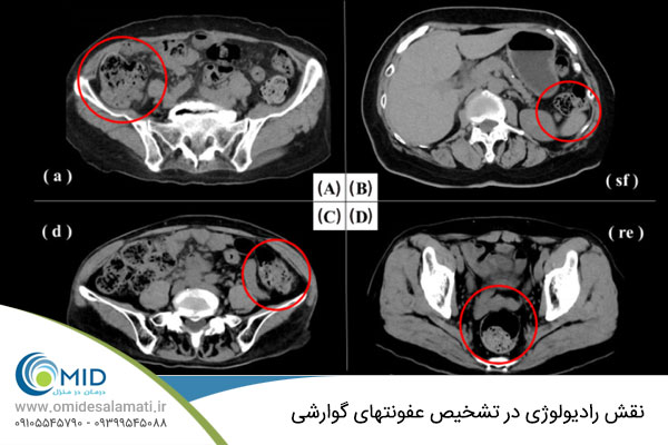 تشخیص عفونت های گوارشی با رادیولوژی