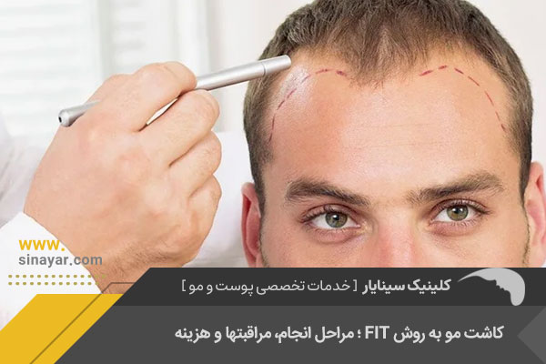 کاشت مو با متد fit در اصفهان