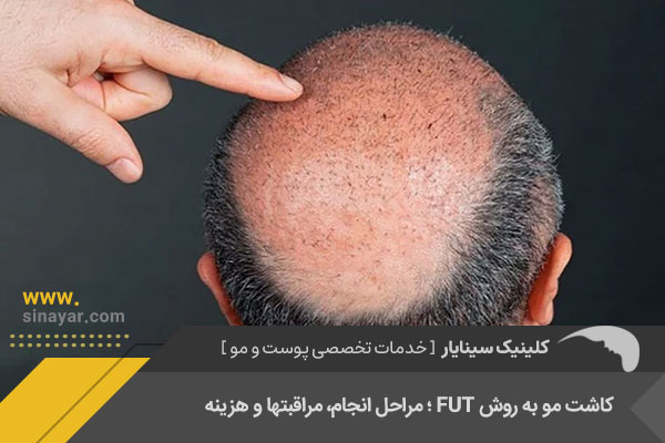 کاشت مو به روش FUT با تراکم بالا در اصفهان