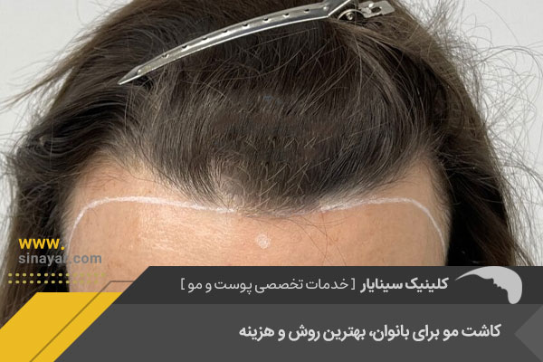 بهترین کلینیک کاشت موی طبیعی زنانه در اصفهان