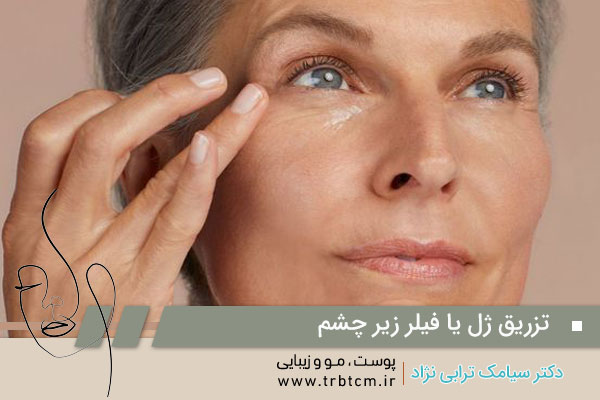 تزریق ژل زیر چشم یوسف آباد