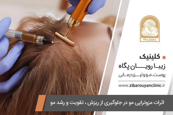 مزوتراپی ضد ریزش مو در اصفهان