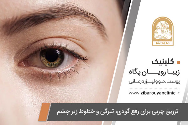 تزریق چربی زیر چشم در اصفهان