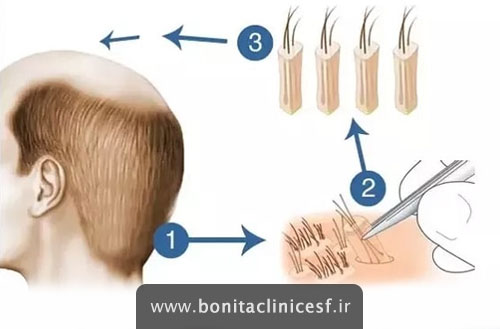 کاشت مو به روش ترکیبی FUT و FIT