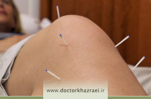 کاربردها و اثرات طب سوزنی در درمان بیماریهای اسکلتی و عضلانی